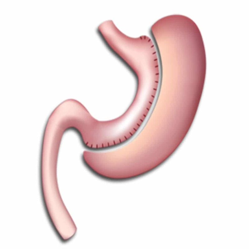 Gastric-Sleeve