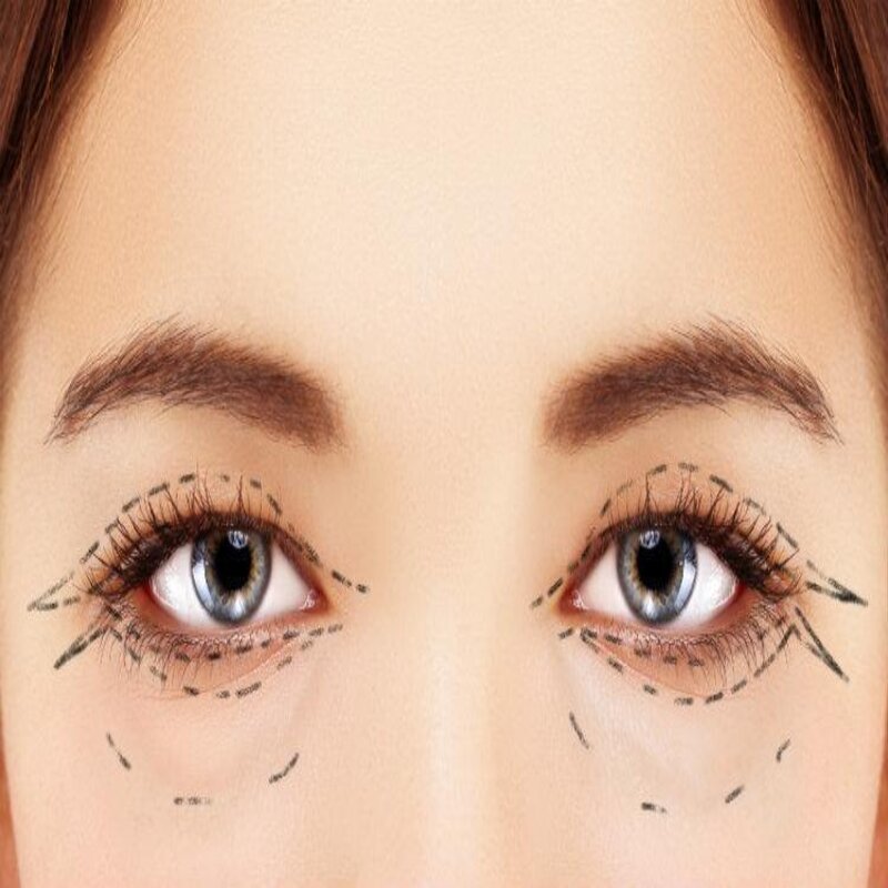 eyelid-surgery (1)