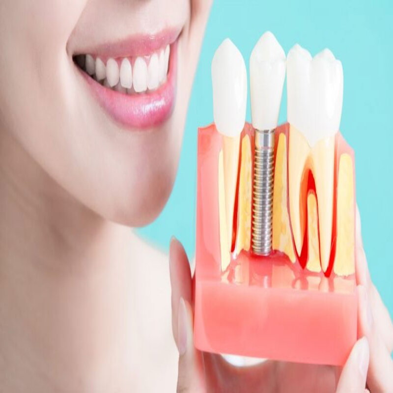 dental implant