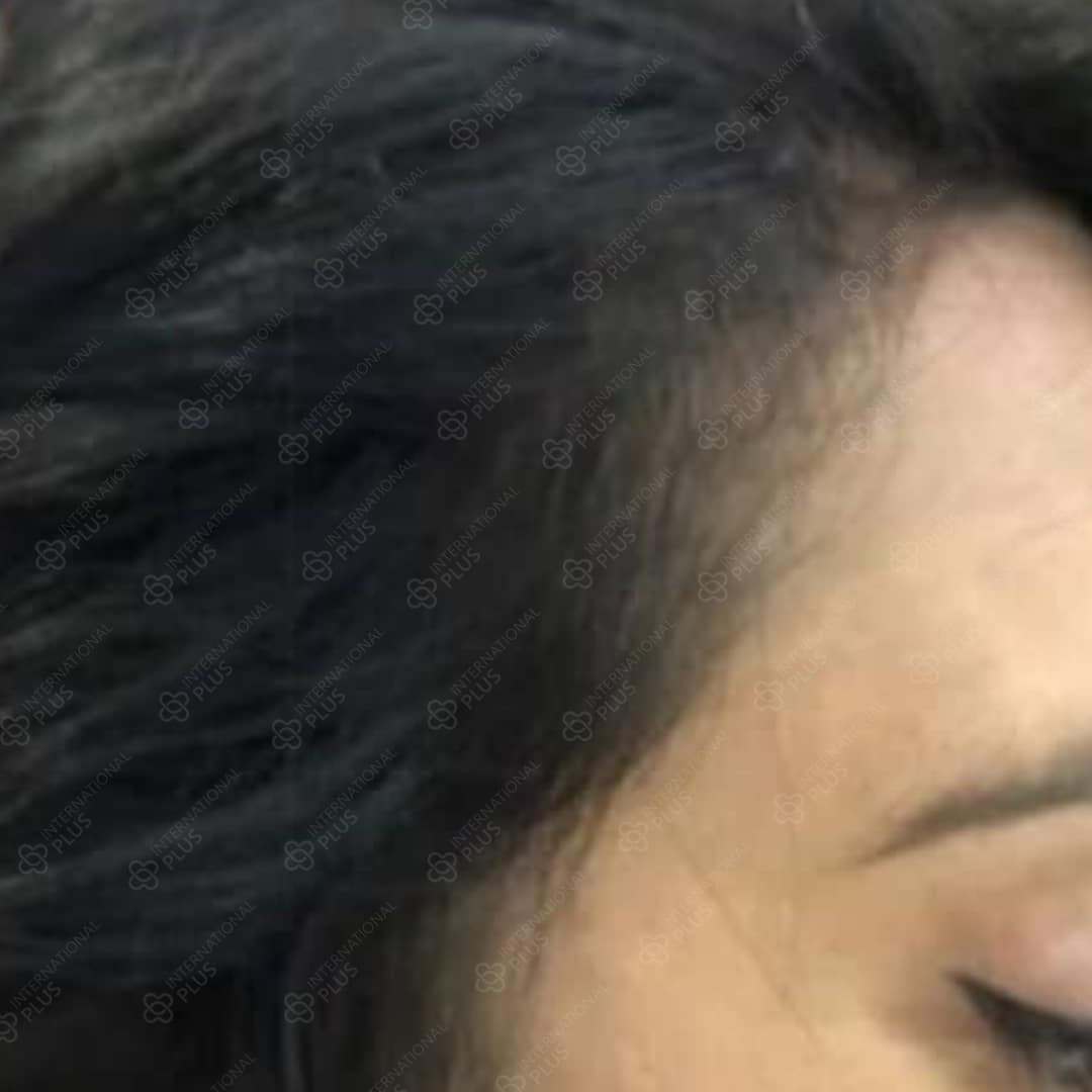 woman-hair-transplant2